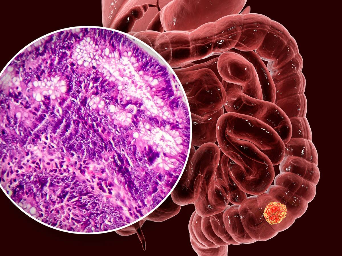 Los pacientes podrán vivir sin quimioterapia: doctor sobre posible nuevo tratamiento para tumores