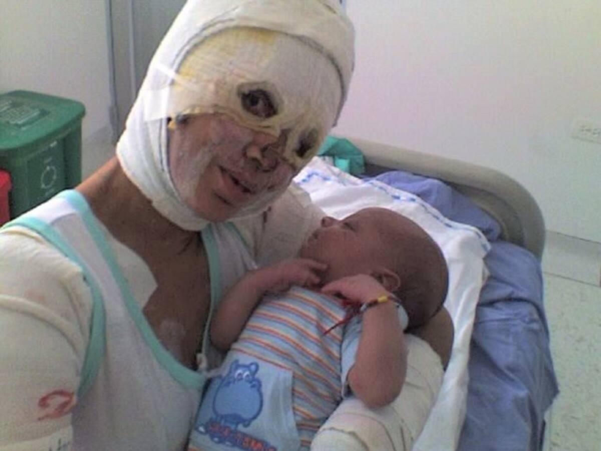 La historia de Diana Ossa y de cómo pudo salvar su embarazo luego de ser quemada