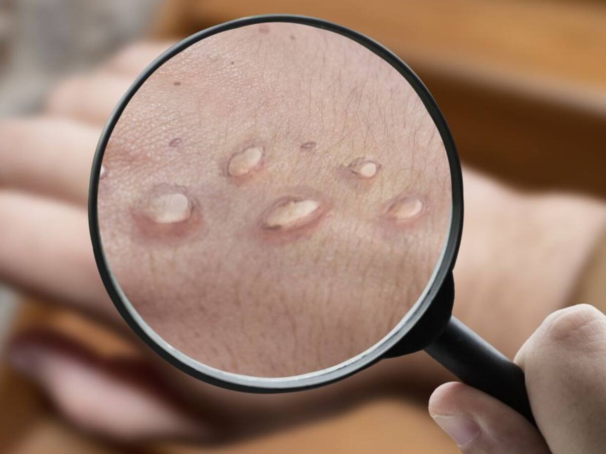 Viruela del mono: Japón detecta su primer caso