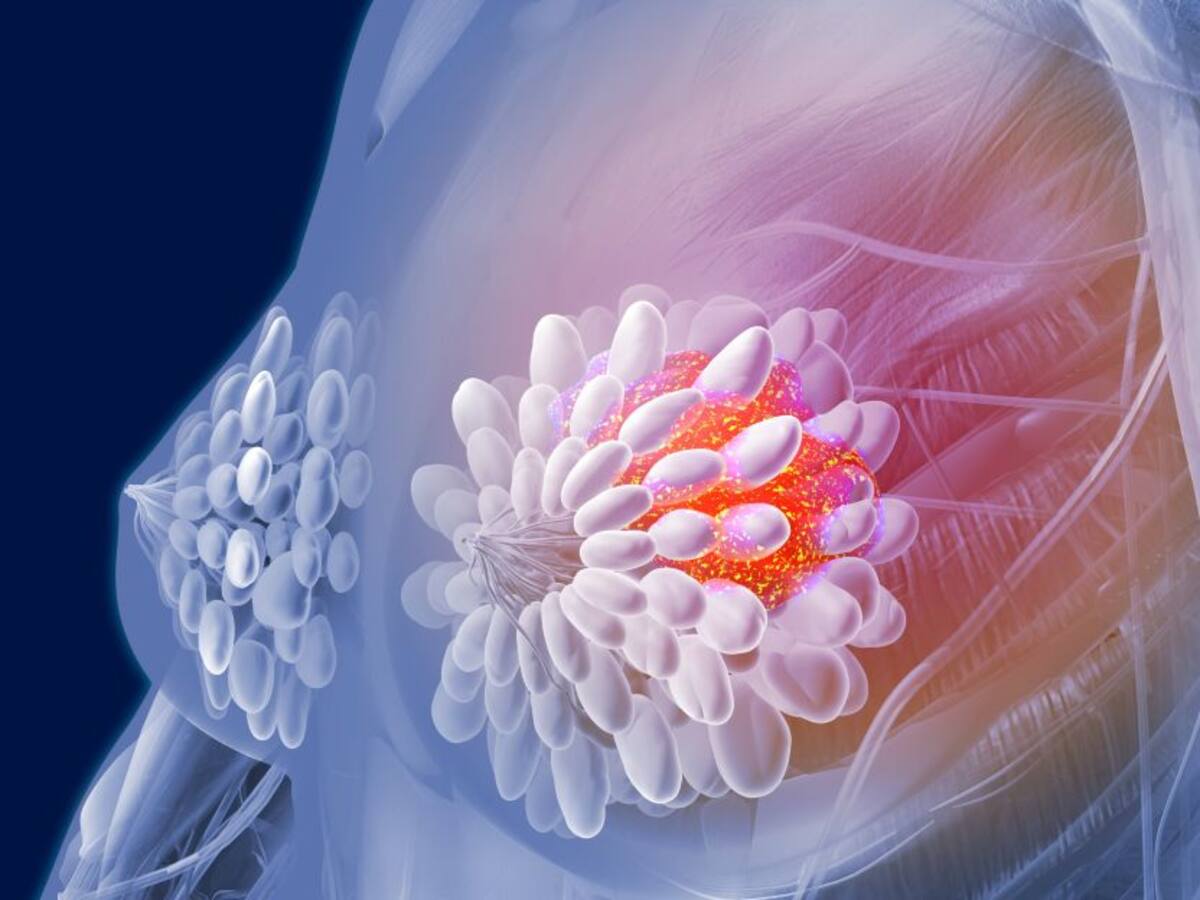 Estudio: la inteligencia artificial ayudaría a diagnosticar cáncer de mama