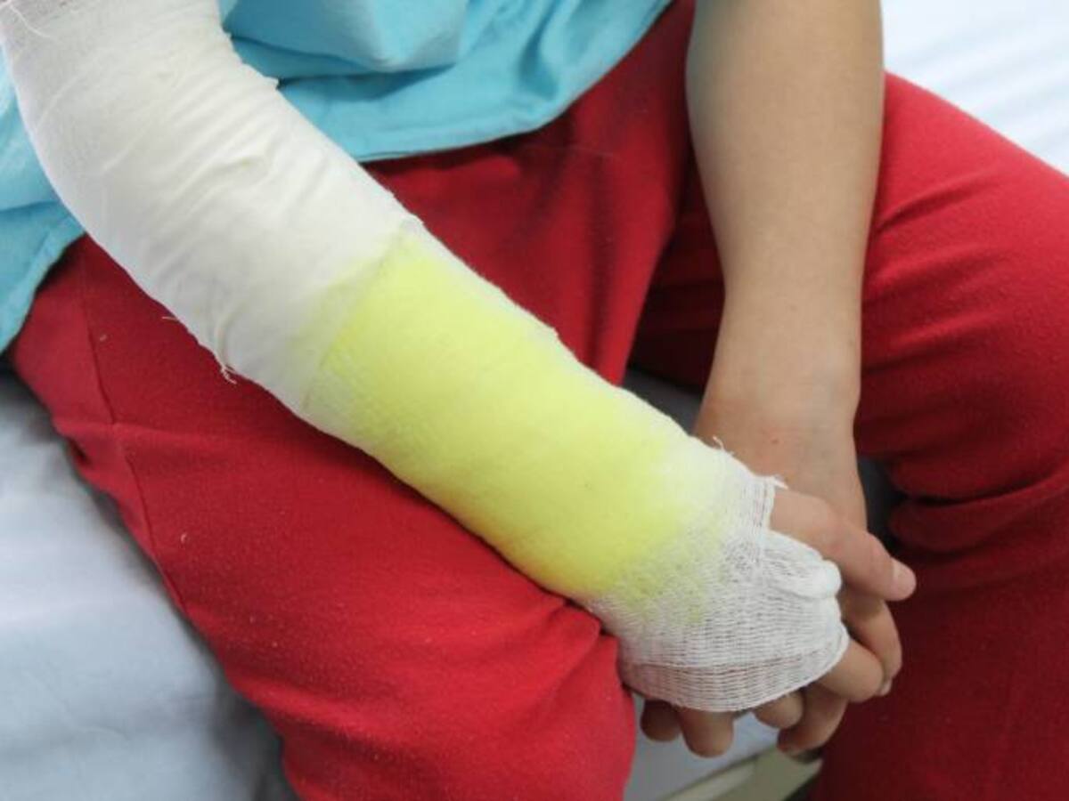 En Antioquia 350 niños se queman con líquidos calientes cada año