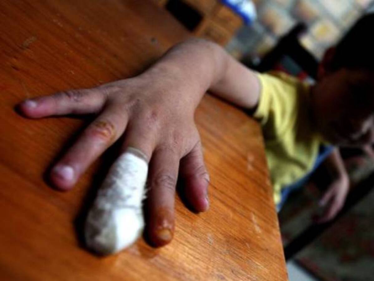 Crece el número de personas quemadas con pólvora en Ibagué