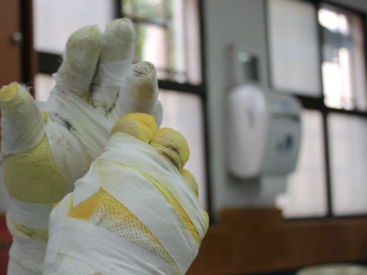 Antioquia, reportó el mayor número de quemados comenzando el año 2020