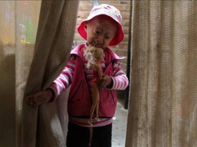 Niña de 8 años en Perú parece anciana de 80