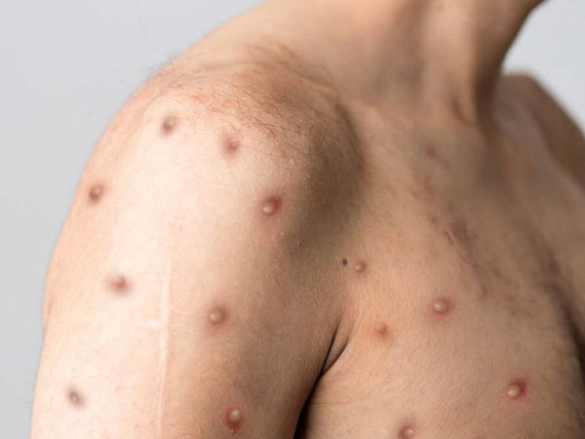 Se intensifica rastreo por viruela del mono