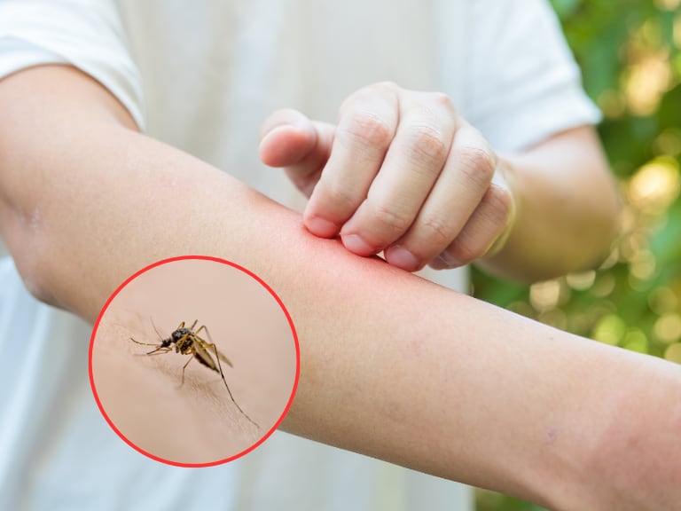 Persona con picazón a causa de una picadura de mosquito (Fotos vía Getty Images)