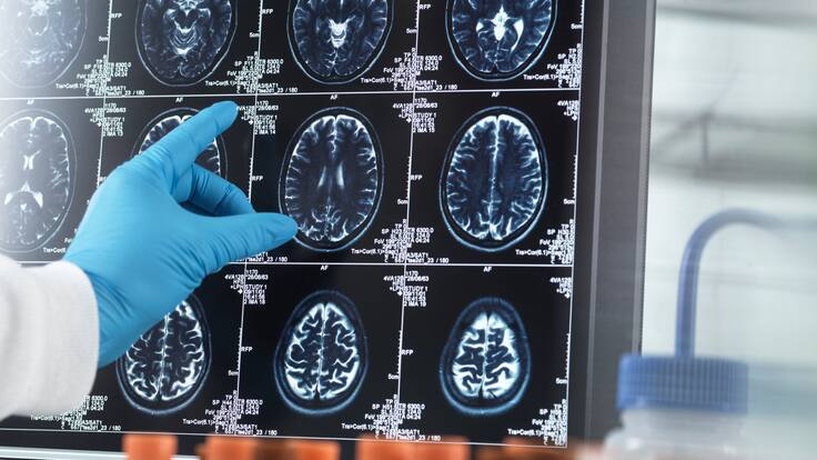 ¿Se puede revertir el alzheimer con una alimentación basada en plantas?