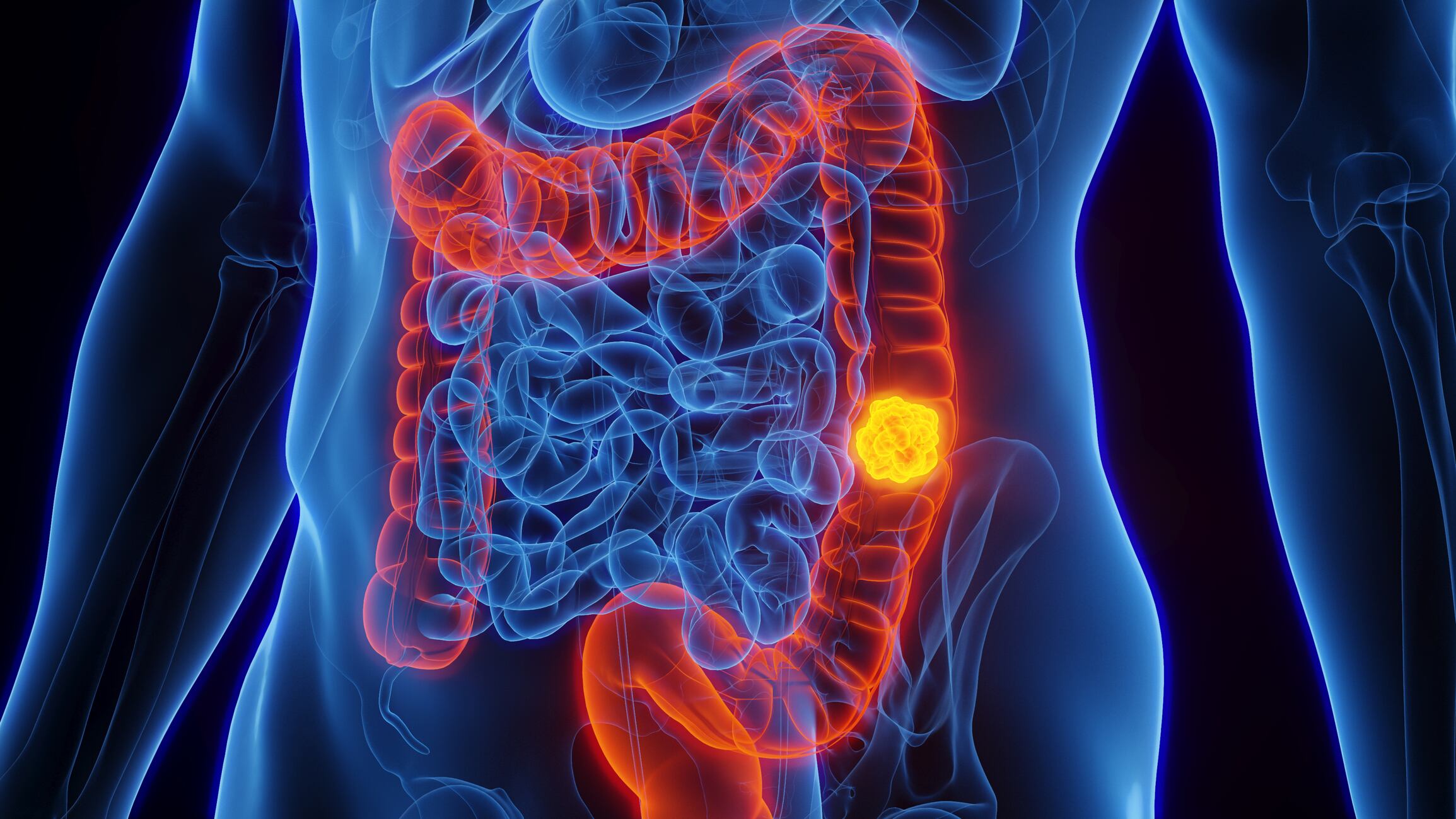 Cáncer de colon // Foto: Getty Images