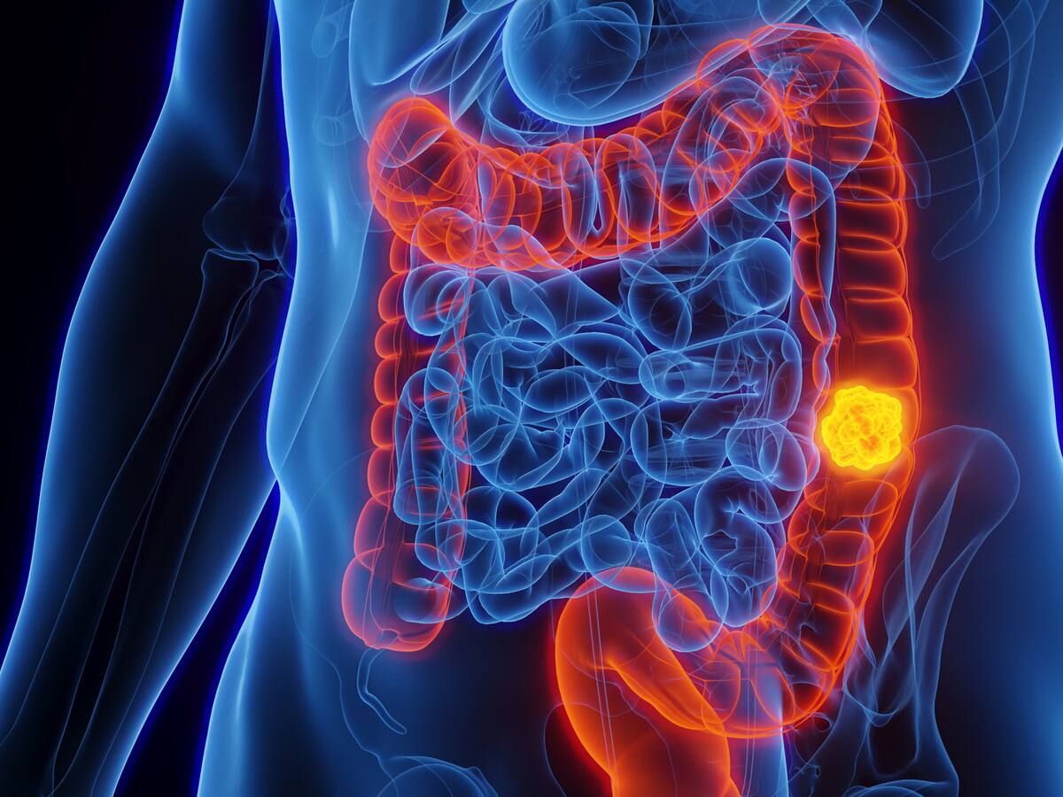 5 causas más comunes que fomentan la aparición de cáncer de colon: la tercera pasa desapercibida
