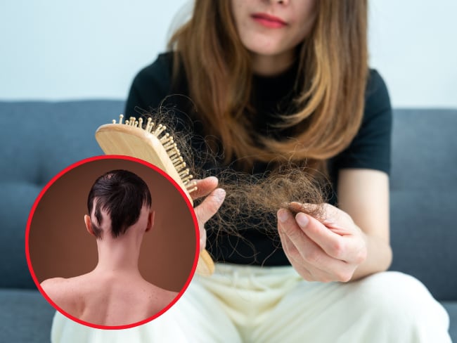 Alternativa para combatir la alopecia sin cirugía en Colombia: este es el avance en la medicina