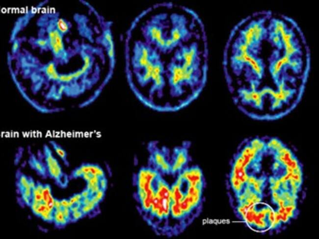 En Colombia 200 mil personas padecen de Alzheimer
