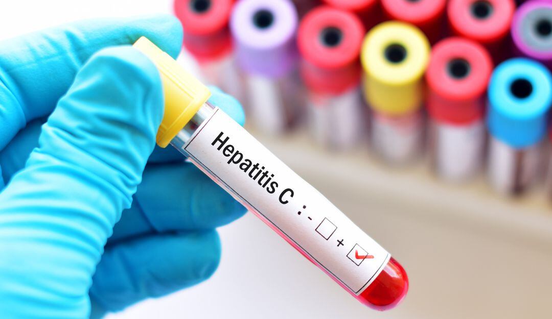 hepatitis C