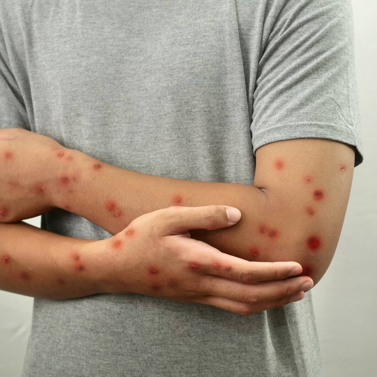 El mpox no implica un confinamiento ni tampoco requiere vacunación masiva: epidemiólogo