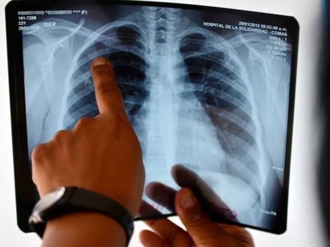 Casos de tuberculosis en UPPV de Pereira / Foto: AFP