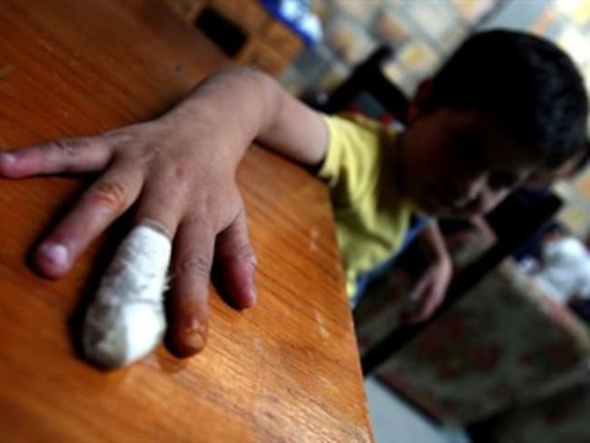 Más de 170 niños se han quemado con pólvora en lo que va de diciembre