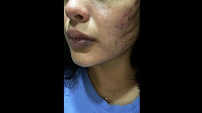 Mujer denuncia agresión por parte de su pareja en Barranquilla. Foto: Silvana Salas (W Radio)