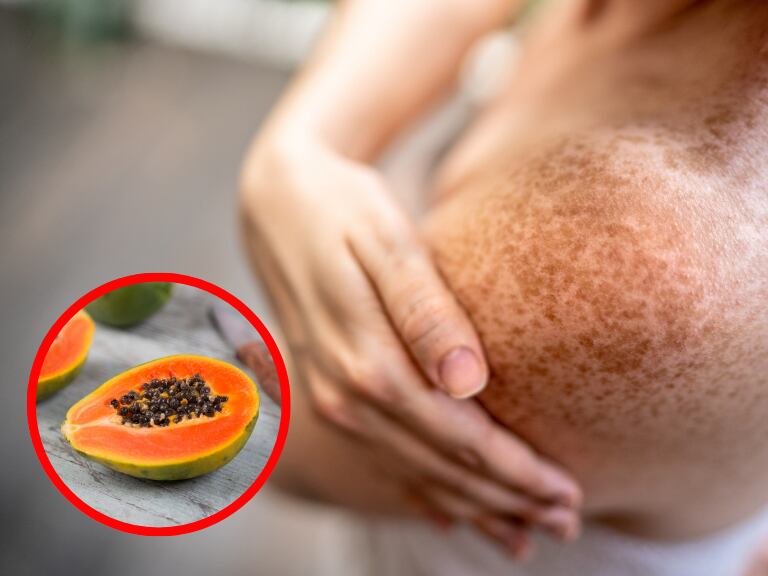 Piel quemada por el sol y papaya, imágenes de referencia: Getty Images