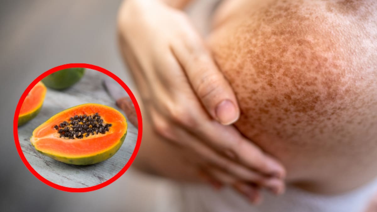 Lista: puré de papaya y más remedios caseros para aclarar la piel quemada por el sol