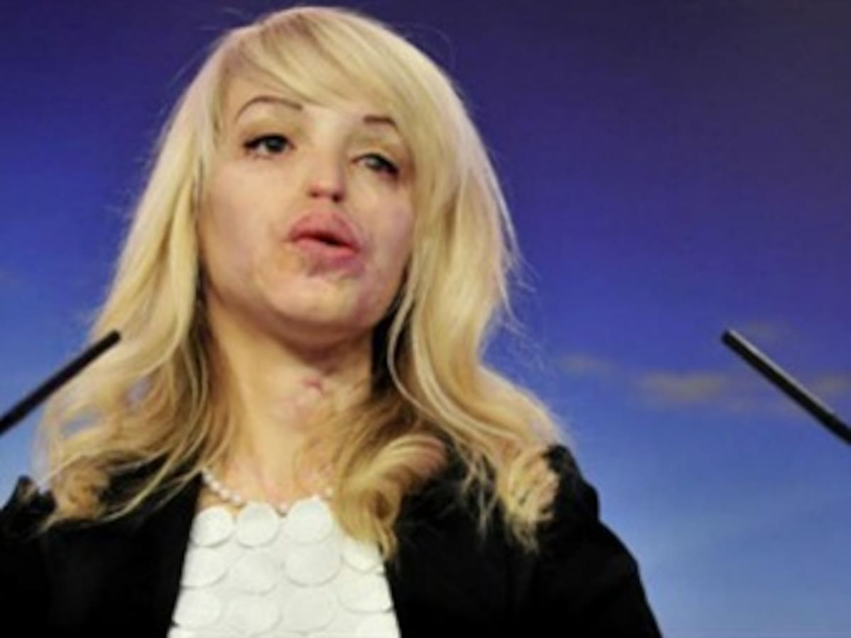 El mundo y sus ataques con ácido