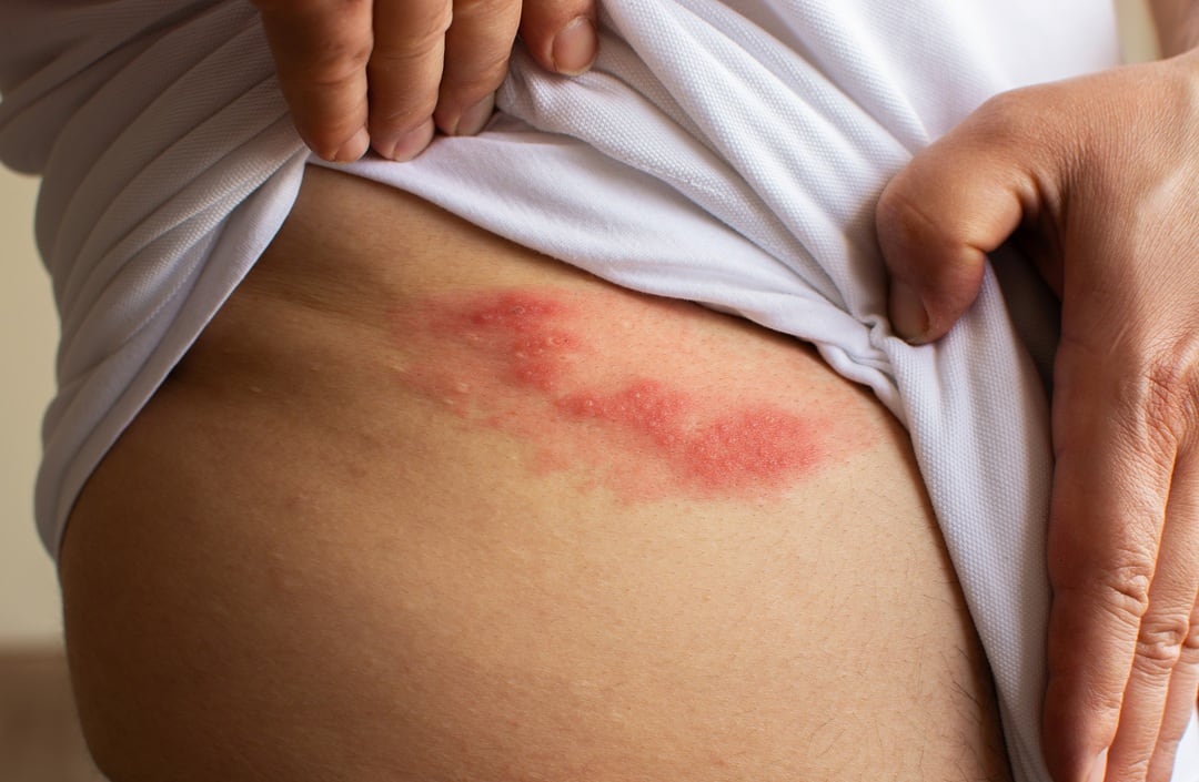 El riesgo de herpes zóster aumenta en personas con enfermedades crónicas o inmunocompromiso