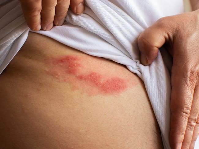 El riesgo de herpes zóster aumenta en personas con enfermedades crónicas o inmunocompromiso