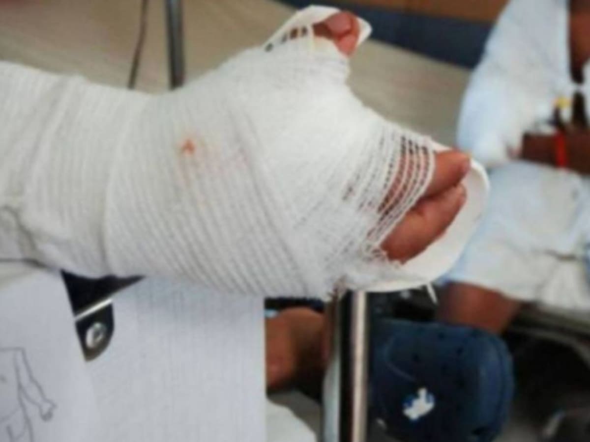 Se reportó un nuevo caso de quemado por pólvora en Manizales