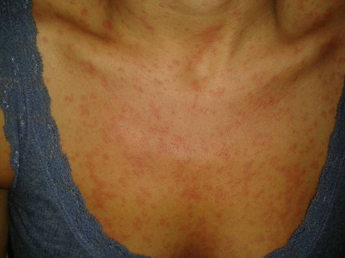 Alarma en Cartagena por caso altamente sospechoso de sarampión