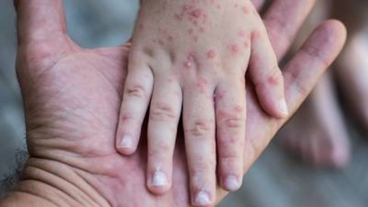 Confirman seis casos del virus coxsackie en un colegio de Pereira