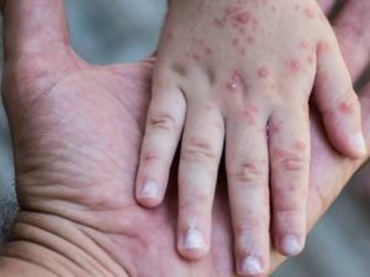 Confirman seis casos del virus coxsackie en un colegio de Pereira