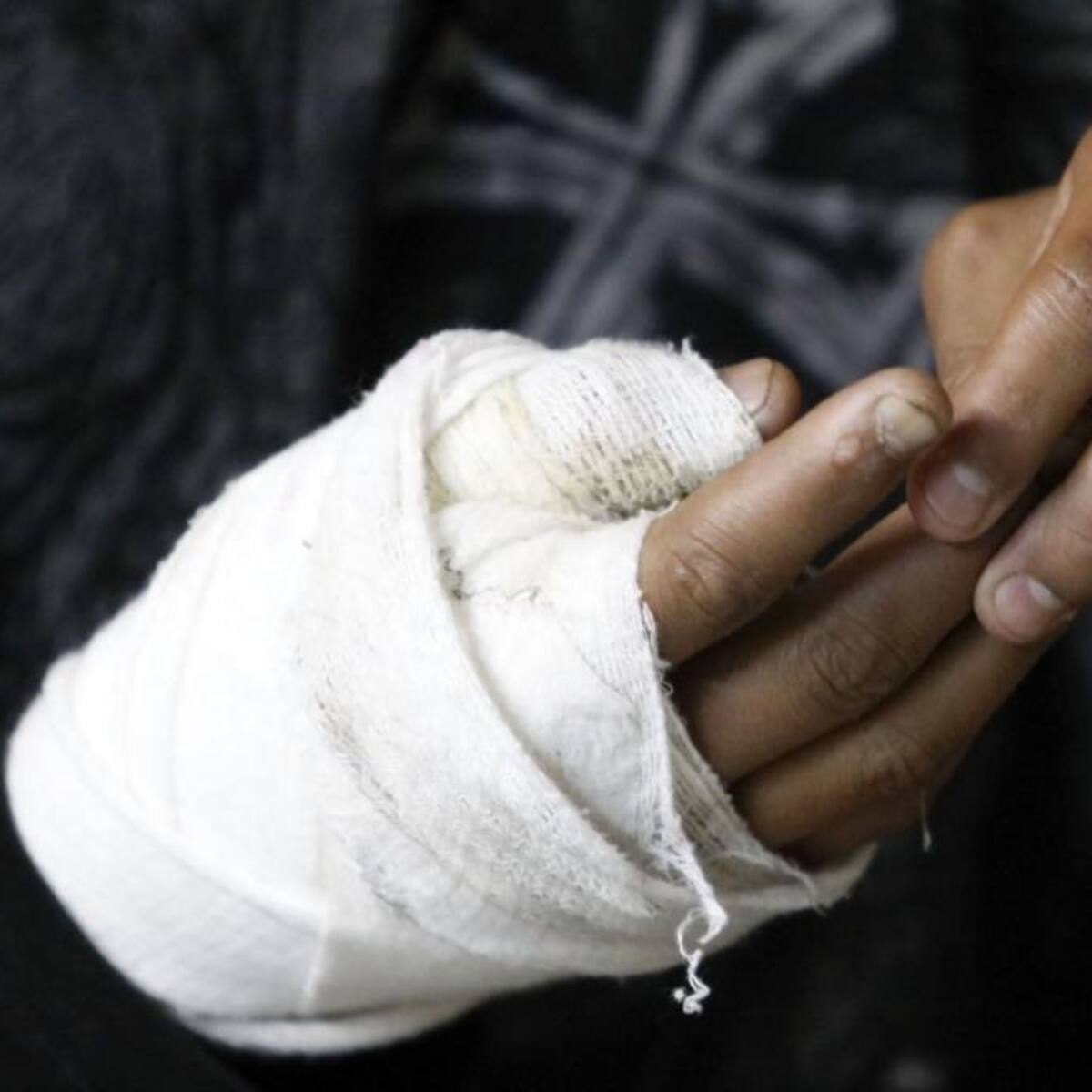 A tres ascienden los quemados con pólvora en el Huila
