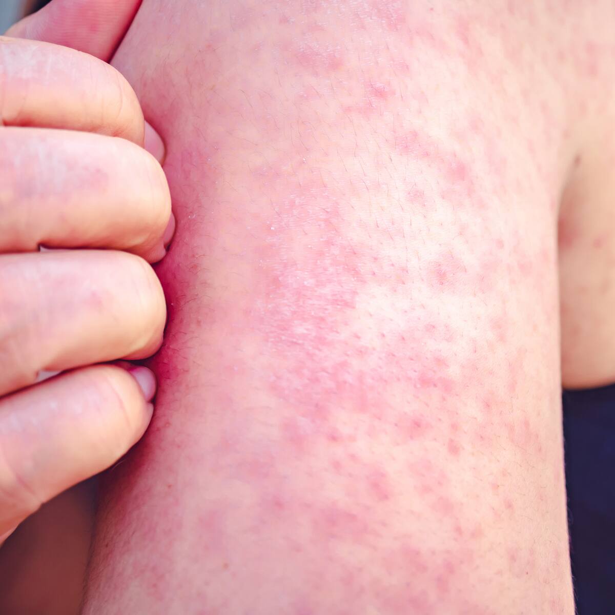 Bogotá detecta un caso de sarampión, un virus altamente contagioso