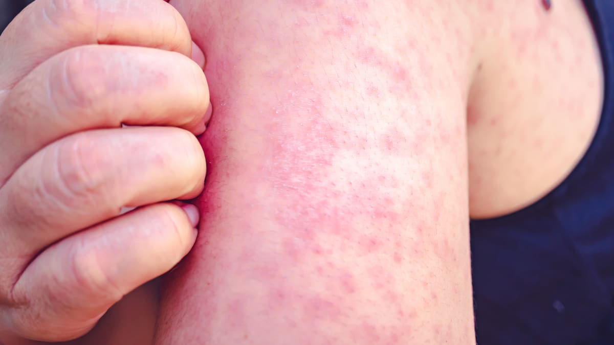 Bogotá detecta un caso de sarampión, un virus altamente contagioso