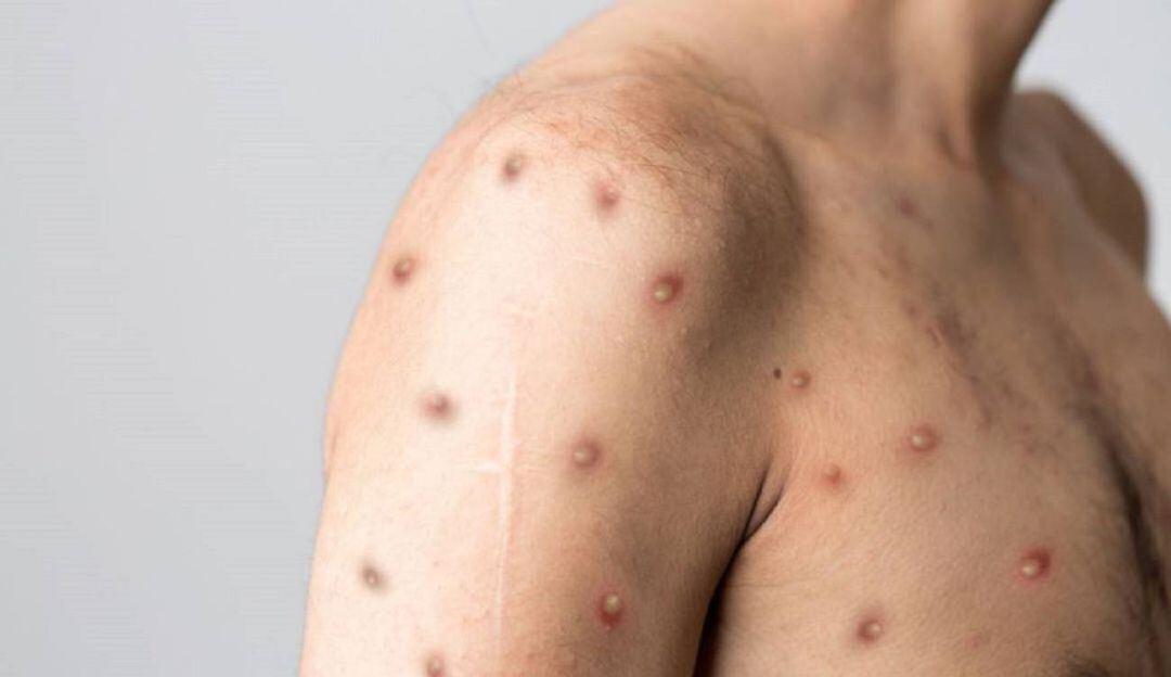 Confirman primer caso de viruela símica en Sucre