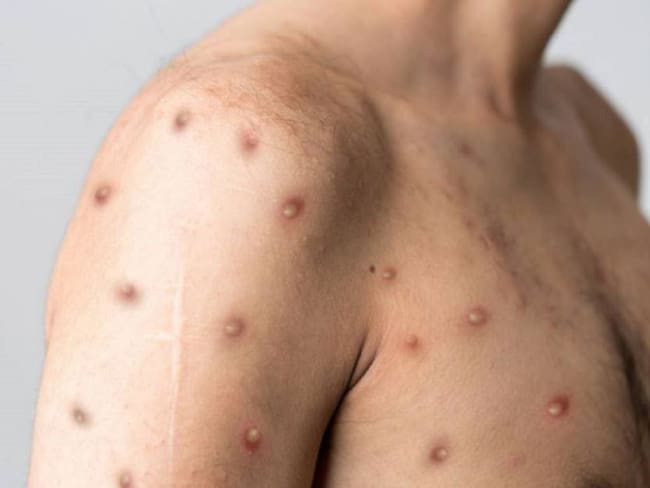 Confirman primer caso de viruela símica en Sucre