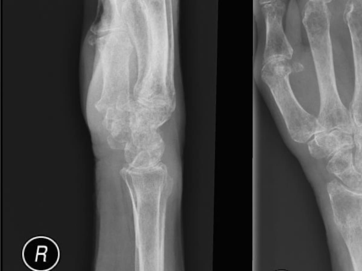 Osteoporosis: prevenir y tratar fracturas óseas con la edad