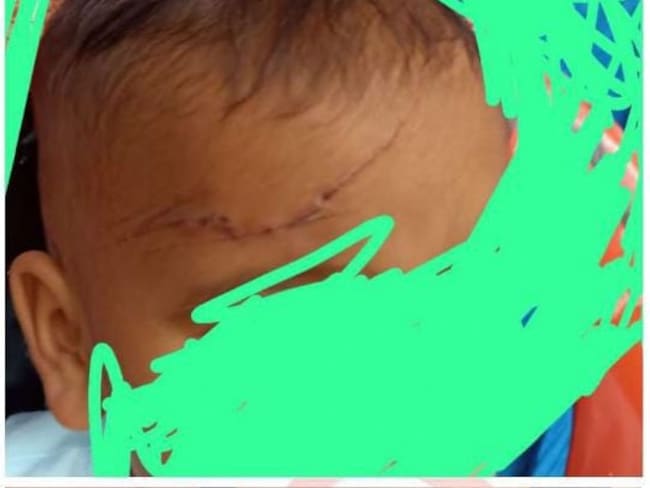 Denuncian que un bebé quedó lesionado con esquirlas de una granada en Remedios