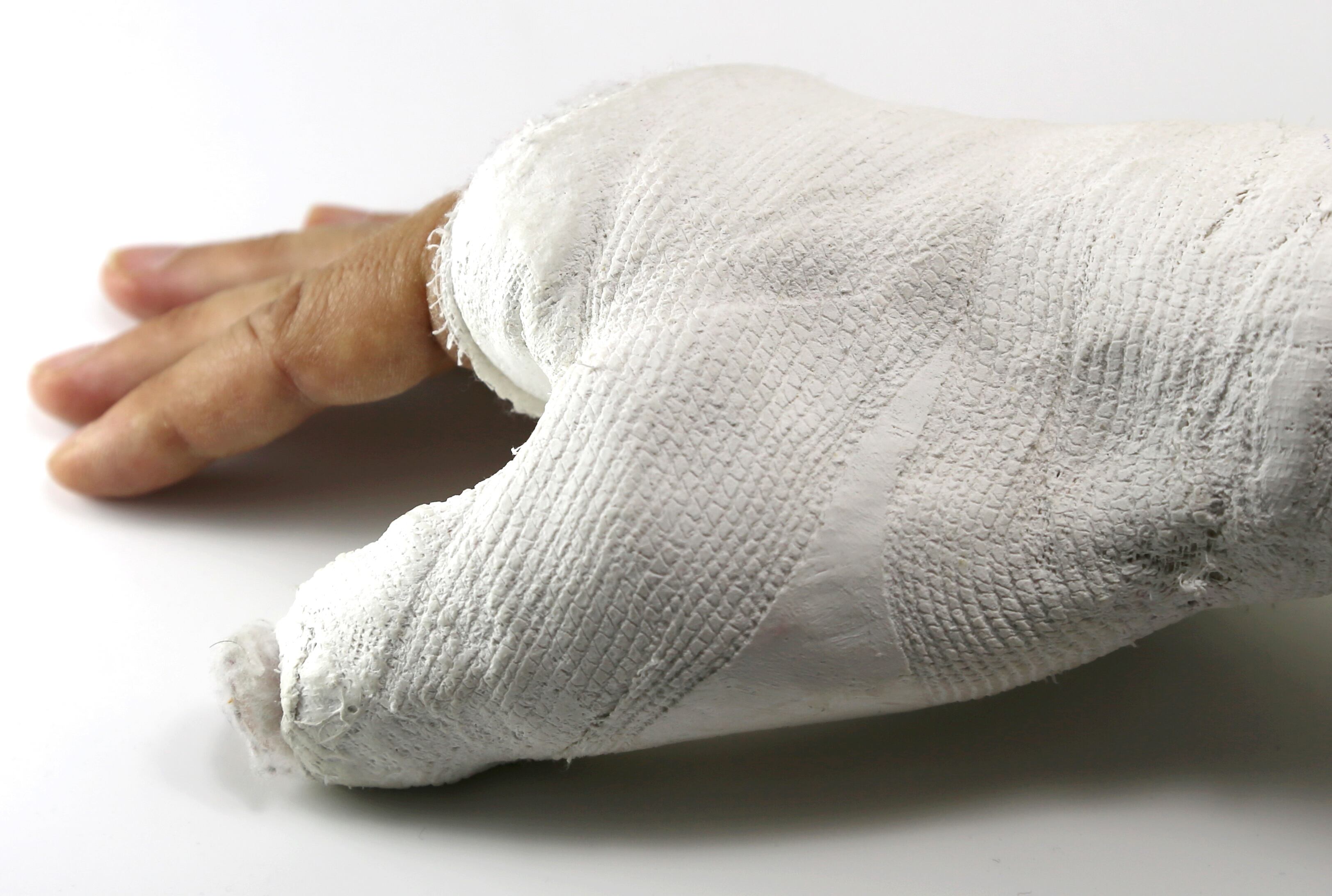 Imagen de referencia de quemadura. Foto: Getty Images