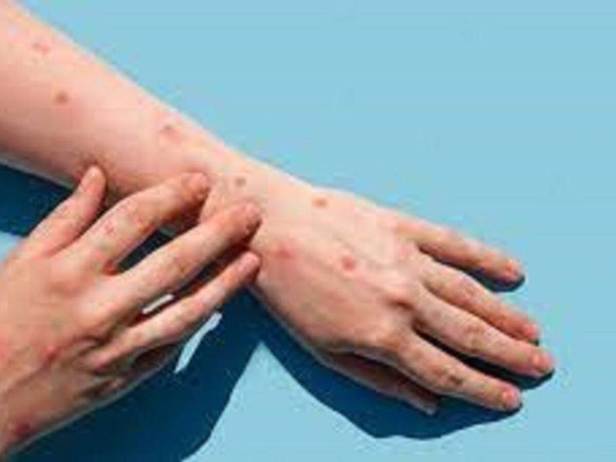 Confirman primer caso de Viruela del Mono en el Huila