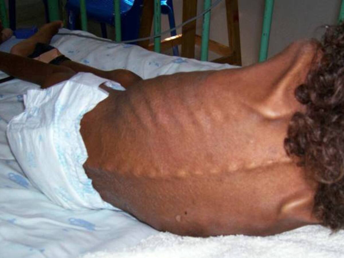 Investigan 33 muertes de niños por desnutrición en el país