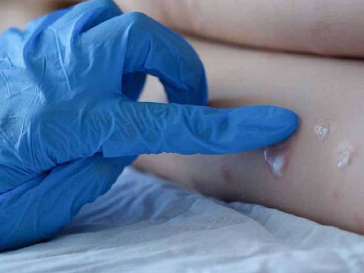 10 casos notificados de la viruela del mono en Bucaramanga