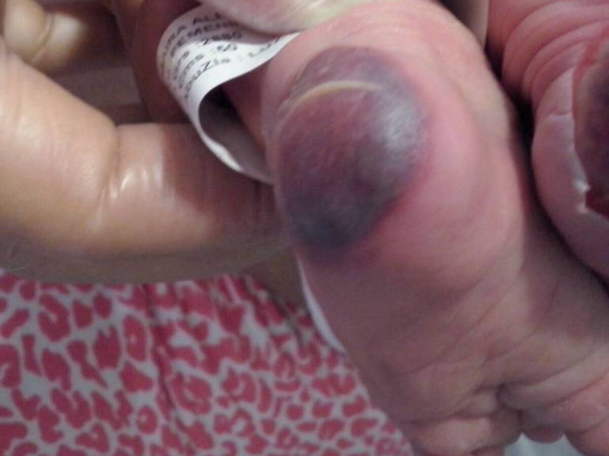 En Medellín, una bebé de cinco horas de nacida fue quemada en una clínica