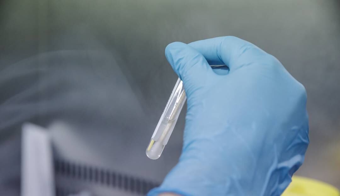 Muestra de prueba PCR para detectar contagio de la viruela del mono en Madrid (España).                           Foto: Getty 