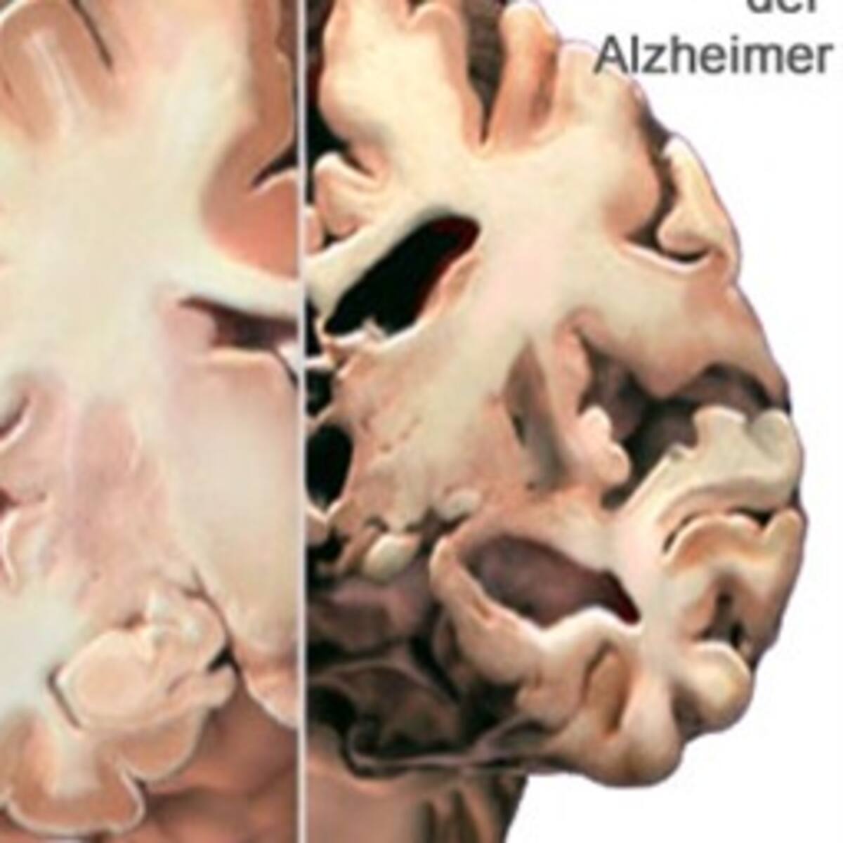 Descubren químico que podría ser clave para tratar el Alzheimer