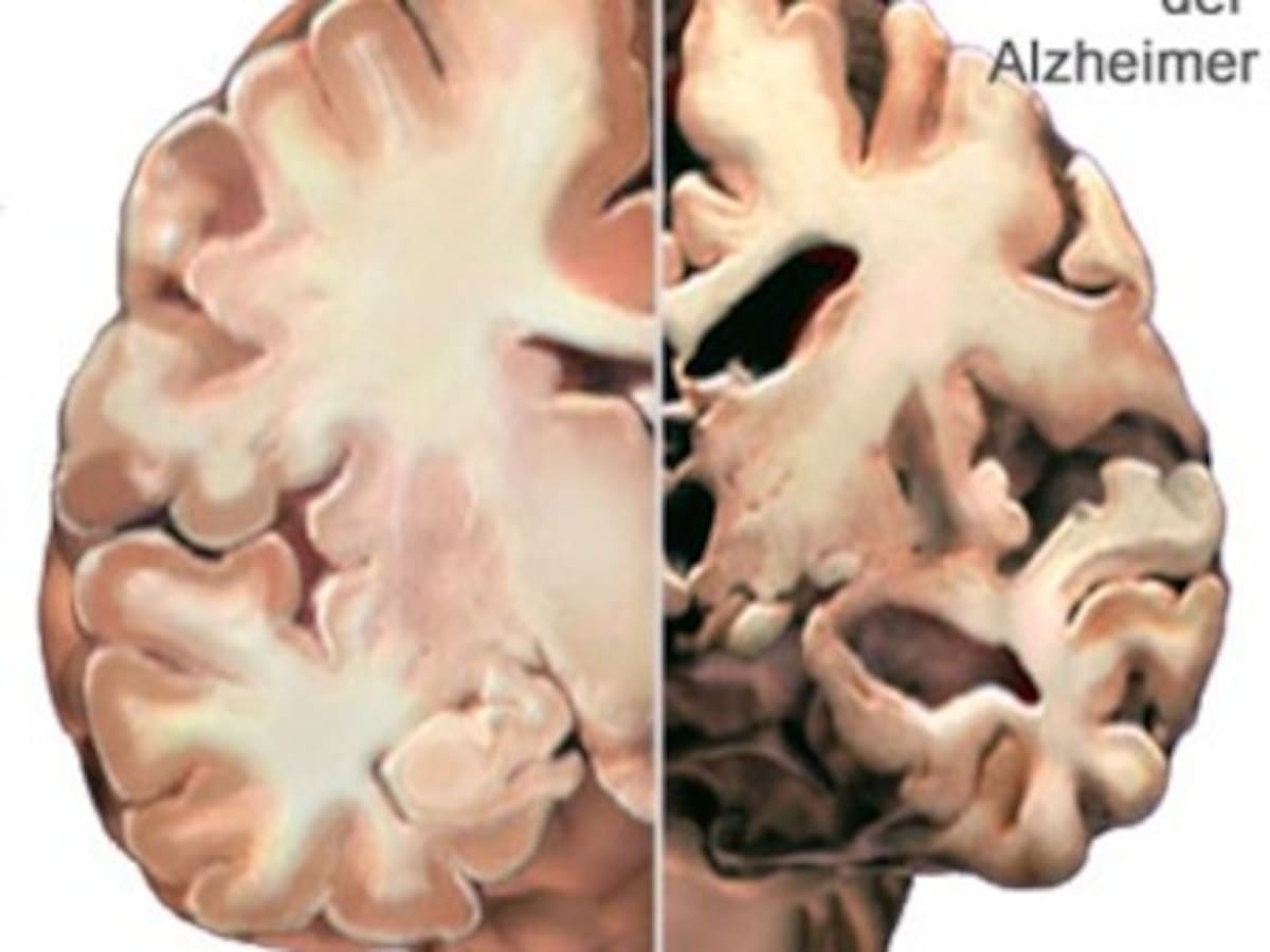 Descubren químico que podría ser clave para tratar el Alzheimer