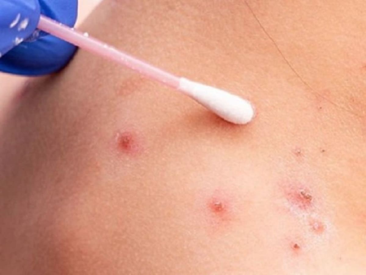 HUEM prepara contingencia por viruela del mono