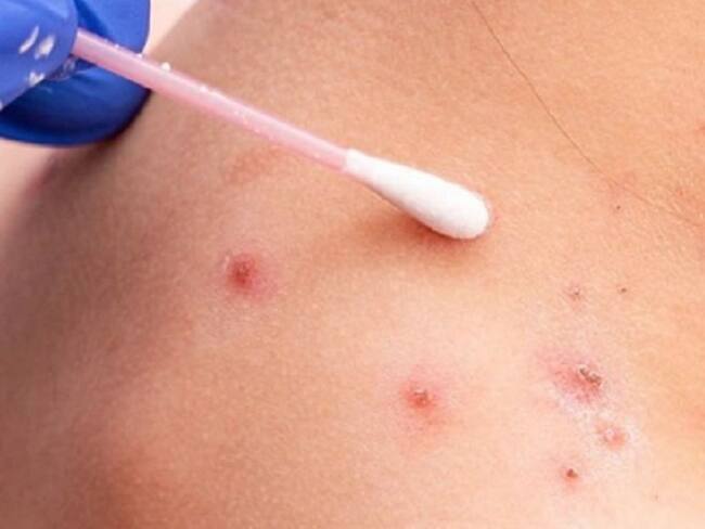 HUEM prepara contingencia por viruela del mono