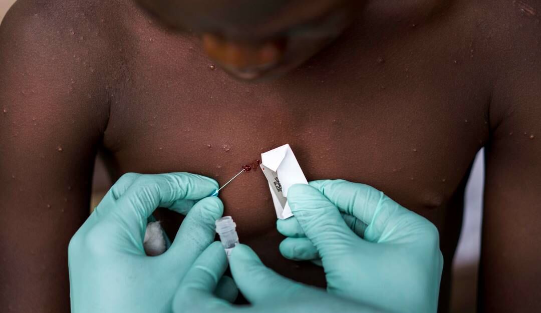Toma de muestras para el estudio de la viruela del mono en África.              Foto: Getty 