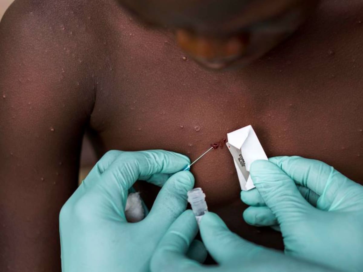 Ecuador y Honduras declaran alerta sanitaria por viruela del mono