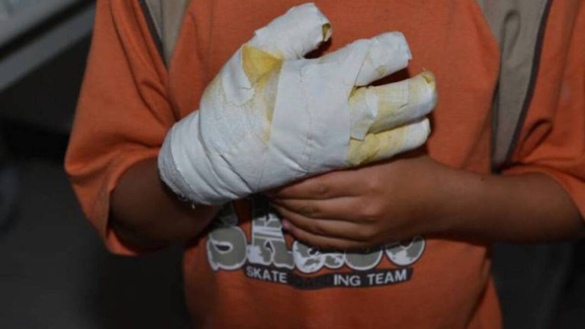 Asciende la cifra de quemados por pólvora en Risaralda
