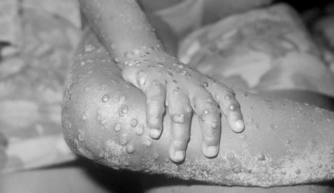 Persona infectada con viruela del mono